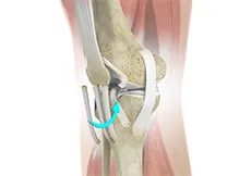 Bone-Patellar Tendon-Bone (BPTB) Allograft