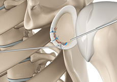 Bony Instability Reconstruction of the Shoulder