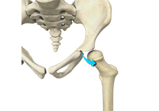 Borderline Hip Dysplasia