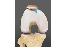 Chondromalacia Patella