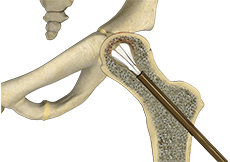 Core Decompression for Avascular Necrosis of the Hip