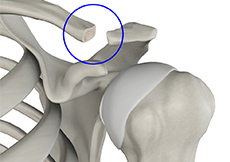 Shoulder Reconstruction Surgery