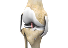 Failed Anterior Cruciate Ligament (ACL) Reconstruction