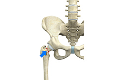 Femoral Neck Fracture