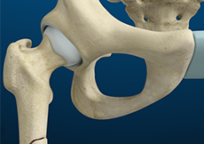 Femoral Shaft Fracture