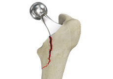 Femur Fracture