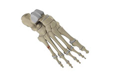 Fifth Metatarsal Fractures