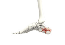 Foot Fracture
