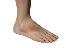 Foot Inflammation