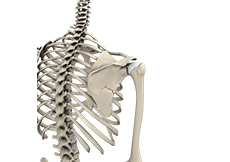 Fracture of the Shoulder Blade (Scapula)