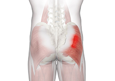Gluteal Strain