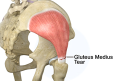 Gluteus Medius Tear