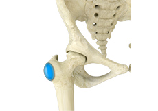 Greater Trochanteric Pain Syndrome