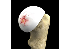 Hip Cartilage Repair