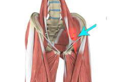 Hip Flexor Strain