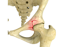 Hip Fracture Surgery
