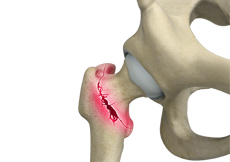 Hip Fracture