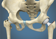 Hip Hemiarthroplasty