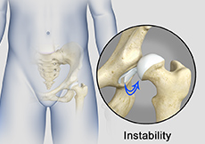 Hip Instability