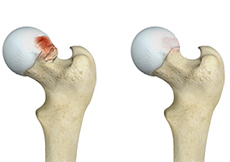 Hip Ligament Injuries