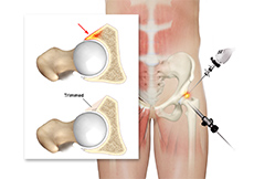 Hip Pincer Resection