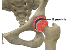 Hip Synovitis