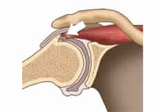 Internal Impingement of the Shoulder