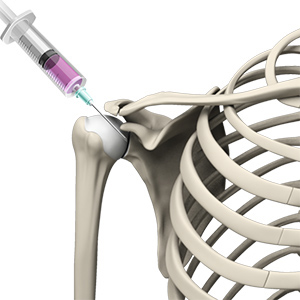 Intraarticular Shoulder Injection