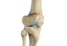 Knee Fracture
