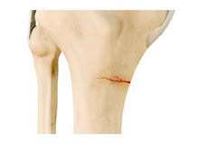 Knee Stress Fractures