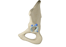 Labral Cysts of the Hip