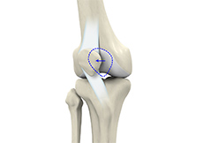 Lateral Patellar Instability