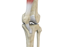 Medial Patellar Instability