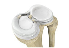 Meniscal Injuries