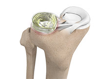 Meniscus Root Repair