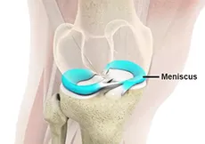 Meniscus Root Tear