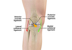 Multiligament Knee Injuries