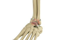 Open Reduction and Internal Fixation of the Foot