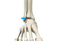 Osteochondral Lesions of the Ankle