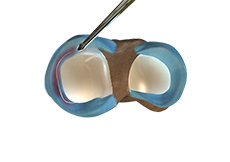 Partial Arthroscopic Meniscectomy