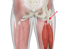 Partial Hamstring Tears