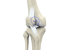 Patellar Instability