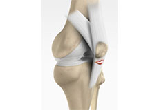 Patellar Tendon Rupture