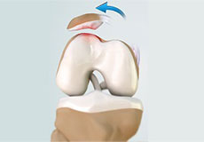 Patellofemoral Instability