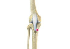 Patellofemoral Realignment