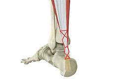 Percutaneous Achilles Repair