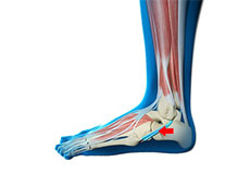 Peroneal Tendon Dislocation