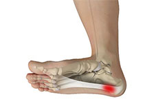 Plantar Fasciitis