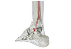 Posterior Tibial Tendon Dysfunction