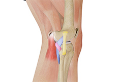Posterolateral Corner Injuries